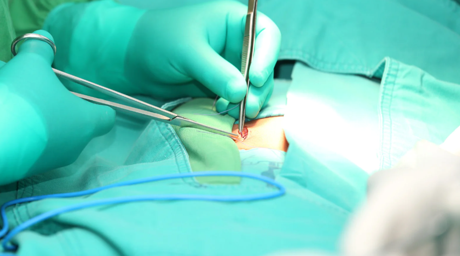 Activity and Exercise After Hernia Surgery